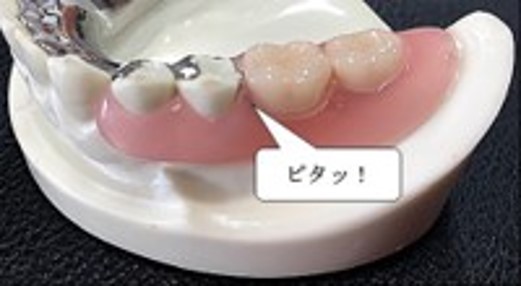 入れ歯治療（見えない入れ歯）